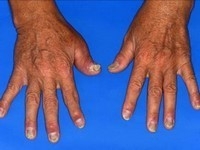 Artrita psoriazica